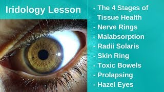 Iridology Lesson  All The Basics Nerve Rings Malabsorption Prolapsing [upl. by Joash]