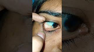 Conjunctival granuloma cyst chronic [upl. by Trudey]