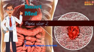 Treatment of peptic ulcer  Antacids  mucosal protective agents and antimicrobial drugs [upl. by Herwig]