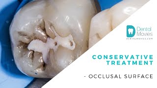 Conservative treatment occlusal surface [upl. by Demmer]