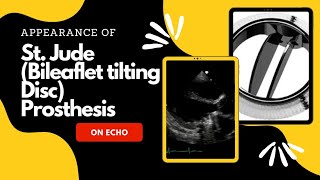 St Jude Mitral Prosthesis on Echocardiography [upl. by Erkan]