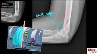 Elbow Xray Interpretation [upl. by Cheffetz]