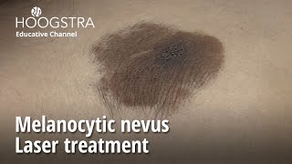 Melanocytic nevus  Laser treatment  24092 [upl. by Nivrek]