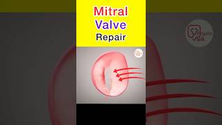 Mitral Valve Repair animation shorts mitralvalve heartsurgery [upl. by Gibeon]