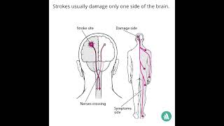 Why Do Strokes Usually Affect Only One Side Of The Body [upl. by Nagey113]