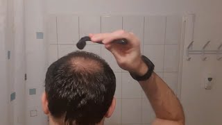 Minoxidil  Derma Roller Results I 4 Months Update [upl. by Eelegna159]