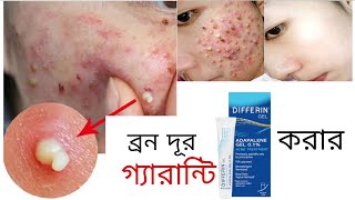 রাতে এই জেল লাগান সকালে ব্রন গায়েব হয়ে যাবে Differin Adapalene Gel  khadija begum  acne treatment [upl. by Tandie]