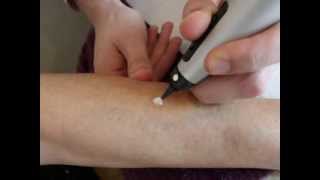 Treatment of a pigmentation spot with cryotherapy  Cryopen [upl. by Ssalguod]