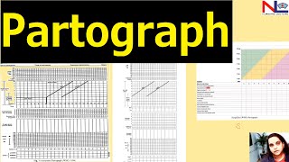 Partograph plotting  Nursing Lecture [upl. by Aerona557]