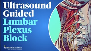 UltrasoundGuided Lumbar Plexus Block [upl. by Ambrosia]