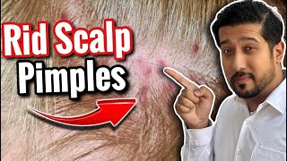 Scalp Pimples Removal  5 Fast and Easy Ways to Get Rid of Scalp Pimples [upl. by Cronin]