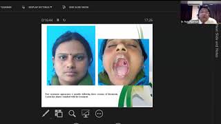 The versatility of Bleomycin the wonder by Dr Rajiv Agarwal Plastic Surgery and Burns SGPGIMS [upl. by Assirem]