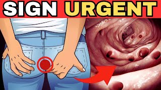 Colon Cancer 7 Symptoms That Require Urgent Investigation [upl. by Fennell]