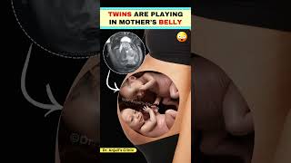 Twins movement in the womb  Fetal movement  Baby Kicks shortsvideo pregnancy love [upl. by Ramos]