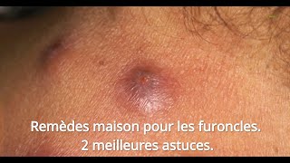 Remèdes Maison Pour Les Furoncles 2 Meilleures Astuces [upl. by Akihsar666]