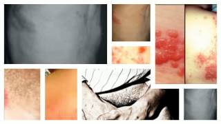 Other Symptoms Of Shingles Rash [upl. by Elauqsap]