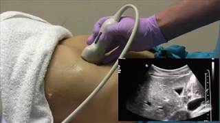 How I do it Ultrasound of the Abdomen [upl. by Aznarepse453]