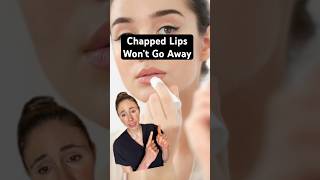 Dry Cracked Lips That Dont Heal dermatologist [upl. by Rezal]