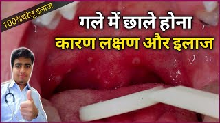 गले और मुंह के छालों का घरेलु इलाज  Home Remedies for Mouth Ulcers  Throat Ulcer Treatment [upl. by Welles]