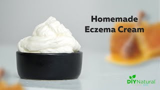 DIY Eczema Cream A Homemade Natural Solution That Works [upl. by Ateiram]