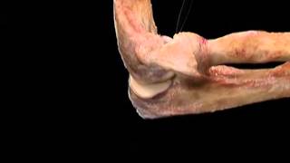 Aclands Video Atlas of Human Anatomy Elbow [upl. by Eelnayr911]