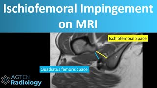 Ischiofemoral impingement on MRI [upl. by Oilla723]