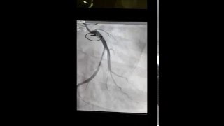 Prosthetic mitral valve and stent in left circumflex artery [upl. by Mohammad]