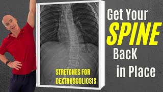 3 Corrective Exercises to Straighten Dextroscoliosis scoliosistreatment scoliosistherapy [upl. by Lerat690]