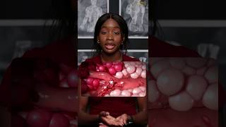 Sickle Cell Anaemia Explained and Simplified [upl. by Yarised]