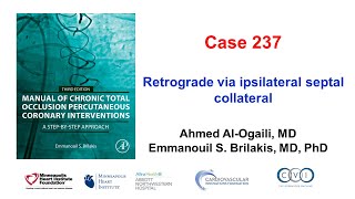 Case 237 Manual of CTO PCI  Retrograde via an ipsilateral septal collateral [upl. by Adnaerb]