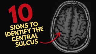 How to find the central sulcus on MRI [upl. by Aihseuqal]