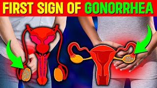 First Sign Of Gonorrhoea Danger How You Will Feel When You Have Gonorrhoea [upl. by Yelnek]