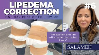 Lipedema Liposuction Demonstration  One Day Post Op Follow Up  Salameh [upl. by Normie]