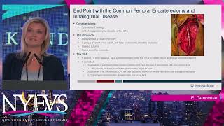 Concomitant CFA and Iliac or SFA Disease Should I Treat Both – Hybrid vs Endo Elizabeth Genoves [upl. by Ahsiet]