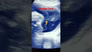 Nuchal CordCirculaire du cordon ombilical Subscribe for more video [upl. by Parry822]