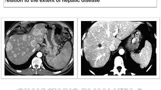 Surgical treatment of liver metastasis of neuroendocrine tumors NETs [upl. by Hernardo328]