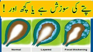 Gallbladder infection  Urdu Hindi  GB disease  Edematous GB [upl. by Ger649]