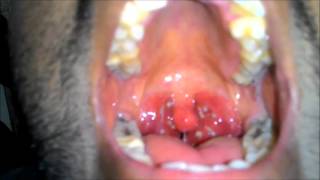 Acute Tonsillitis with Tonsillar exudates [upl. by Kalle]