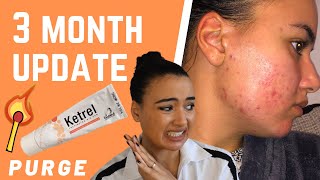 MY SKIN IS WORSE 😩 TRETINOIN CREAM PURGE  3 MONTH UPDATE [upl. by Terhune]