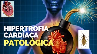 HIPERTROFIA CARDÍACA DO TIPO PATOLÓGICA  CARDIOMEGALIA [upl. by Ylurt]