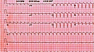 Ventricular Arrythmias and Sudden Cardiac Death  Presentation [upl. by Nylavad17]