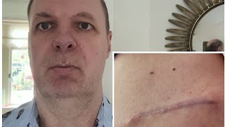 I was Diagnosed with Skin Cancer Melanoma Gevonden op moedervlek huidkankerMelanoom [upl. by Jobie607]