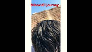 Minoxidil and finasteride journey 1 year unexpected results 😳 [upl. by Aitan]