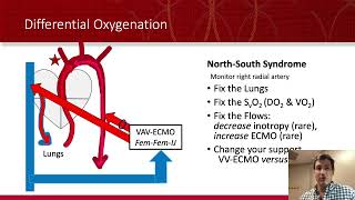 ECMO VA ECMO For Dummies [upl. by Eynenihc474]