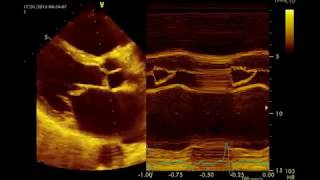 Insuffisance mitrale Sévère par rupture de cordagequotMitral Prolapsequot القصور التاجي الحاد [upl. by Kimmie]