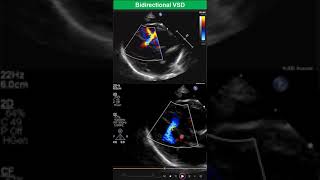 Bidirectional Ventricular Septal Defect Early Stage of Eisenmenger Syndrome [upl. by Gilud]