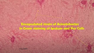 Acinetobacter in clinical sample Sputum Gram stain Microscopy at various magnifications [upl. by Davena]