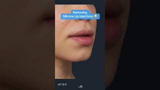 The Dark Side of Silicone Lip Injections A Warning [upl. by Gus500]