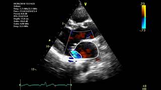 Echocardiographic assessment of the mitral valve [upl. by Orvie]