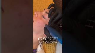 Cryoprobe pen for Melasma spots removal Before and after video and photos cryoprobe melasma [upl. by Templa]